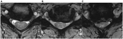 Evidence-based commentary on the diagnosis, management, and further research of degenerative cervical spinal cord compression in the absence of clinical symptoms of myelopathy
